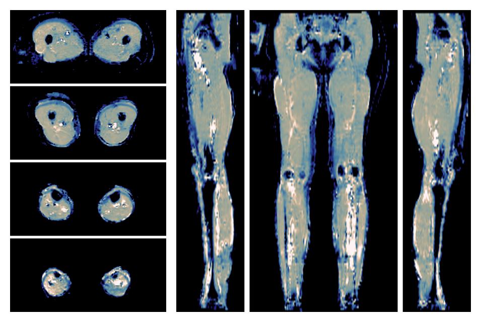 IVIM corrected whole leg muscle mean diffusivity obtained from diffusion tensor imaging.