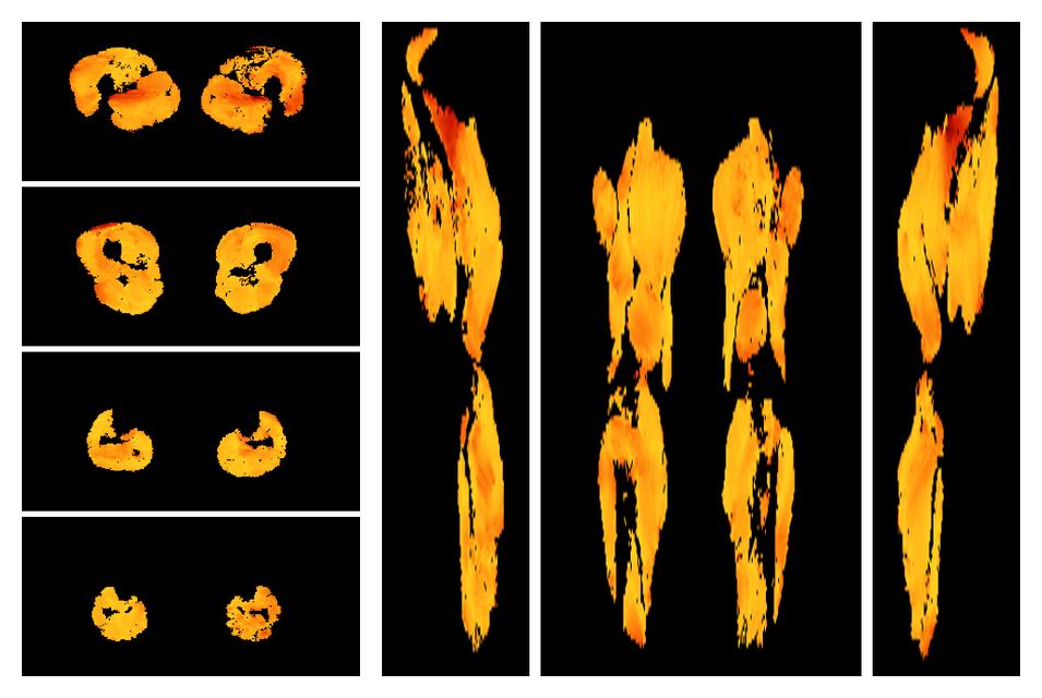 Muscle fiber tract angle map based on whole leg DTI based fiber tractography.