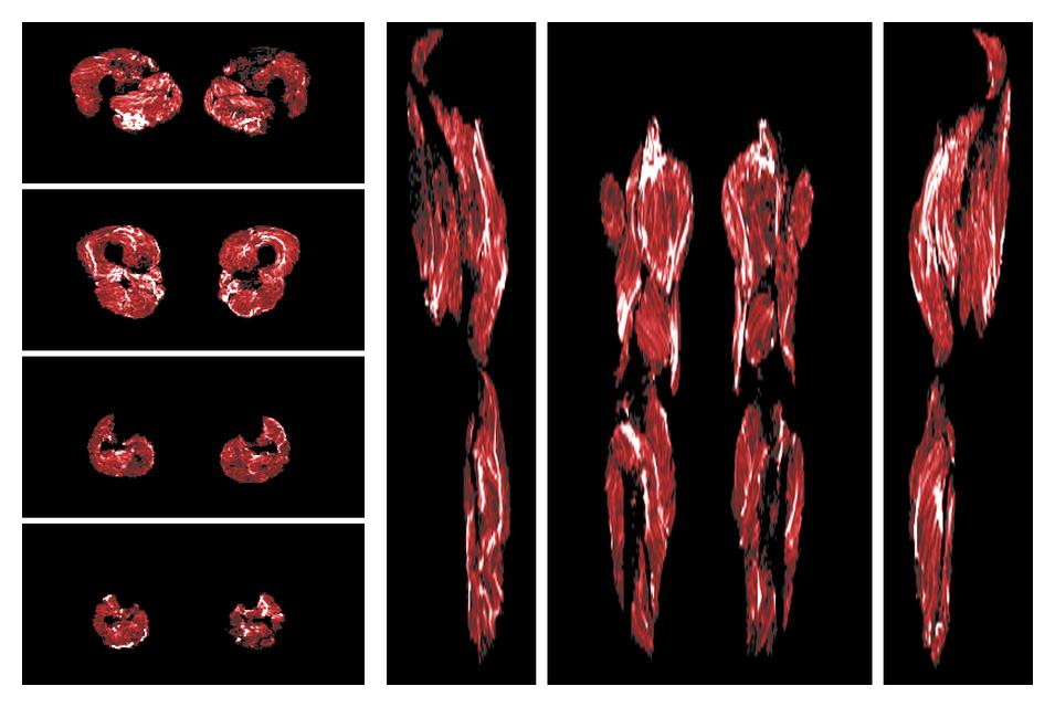 Muscle fiber tract density map based on whole leg DTI based fiber tractography.