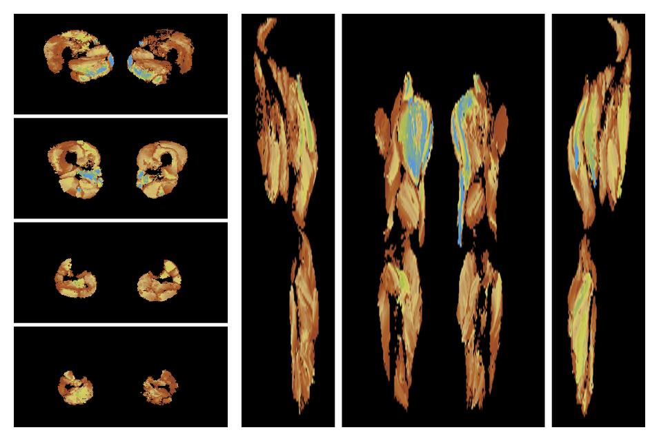 Muscle fiber tract length map based on whole leg DTI based fiber tractography.