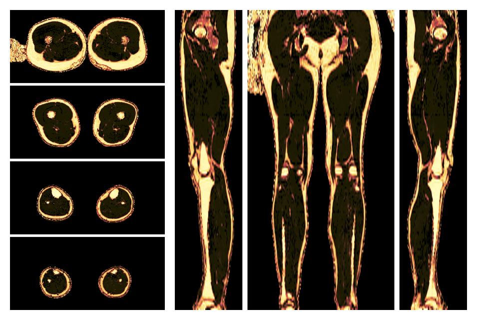 The fat fraction of the lower extremity obtained from the dixon reconstruction for muscle water fat quantification.