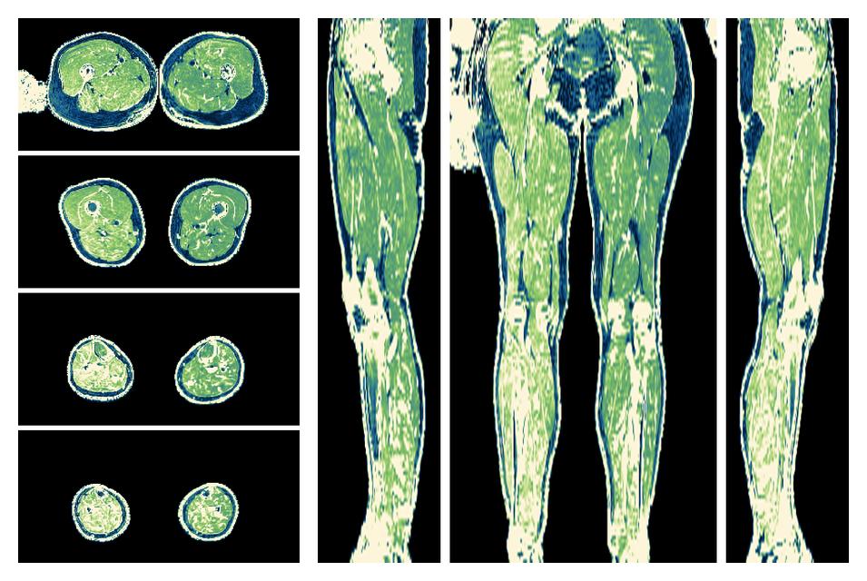 The R2 star relaxation time of the lower extremity obtained from the dixon reconstruction for muscle water fat quantification.