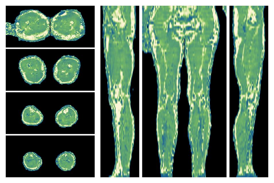 The water only T2 relaxation time of the lower extremity obtained from multi echo spin echo t2 mapping with EPG based reconstruction.