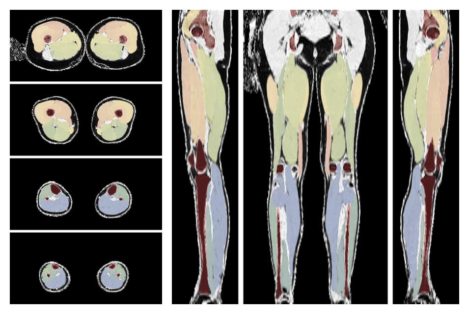 Overlay of automated muscle segmentation labels on dixon water image.