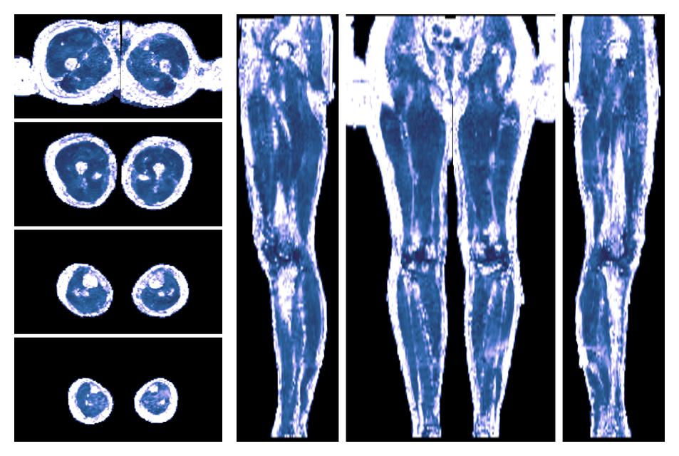 IVIM corrected whole leg muscle fractional anisotropy obtained from diffusion tensor imaging.