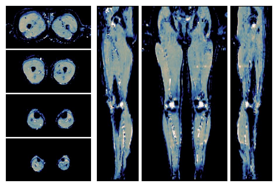 IVIM corrected whole leg muscle mean diffusivity obtained from diffusion tensor imaging.