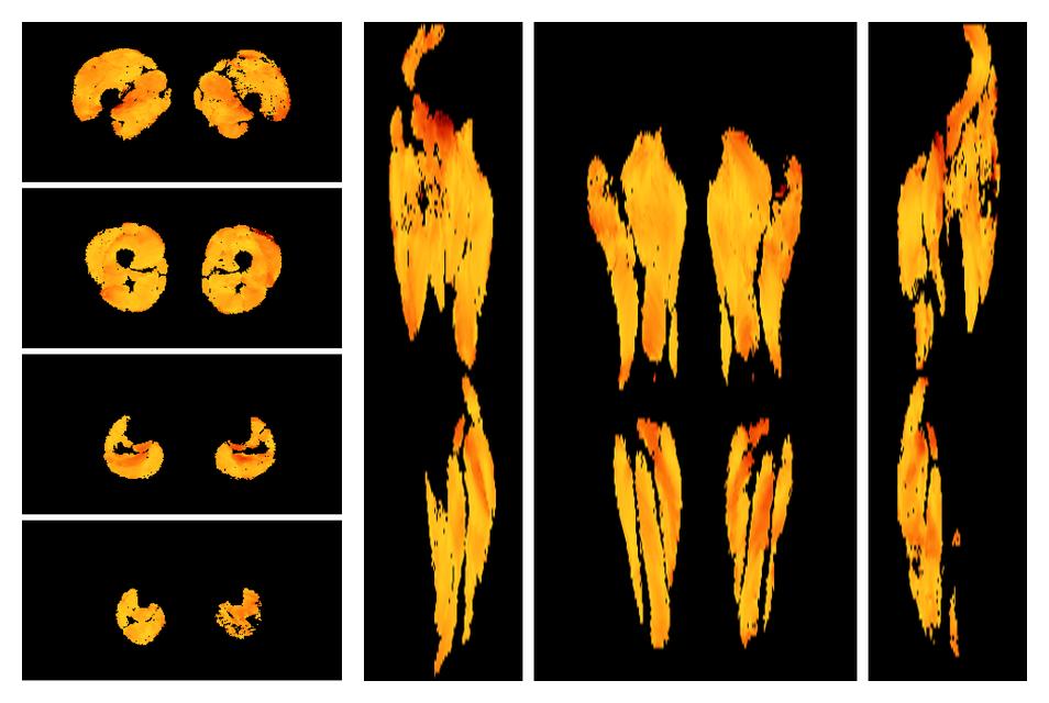 Muscle fiber tract angle map based on whole leg DTI based fiber tractography.