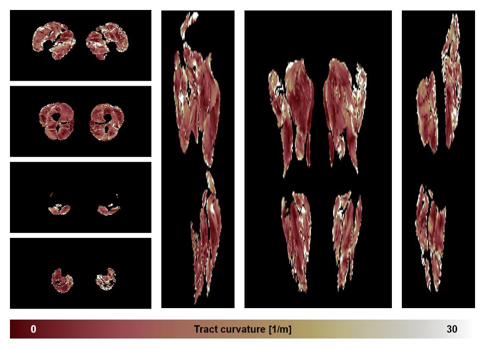 Muscle fiber tract curvature map based on whole leg DTI based fiber tractography.