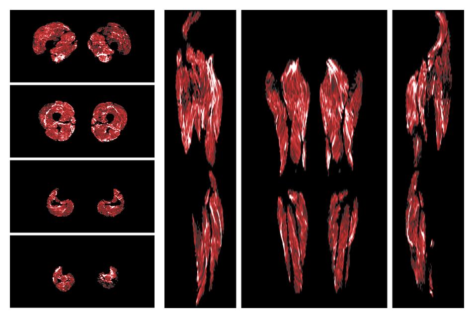 Muscle fiber tract density map based on whole leg DTI based fiber tractography.