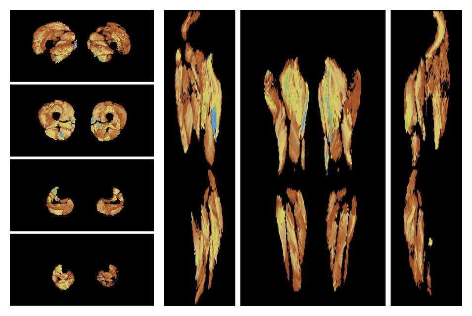 Muscle fiber tract length map based on whole leg DTI based fiber tractography.