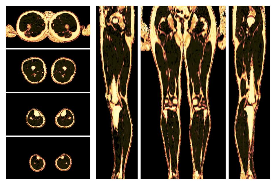 The fat fraction of the lower extremity obtained from the dixon reconstruction for muscle water fat quantification.