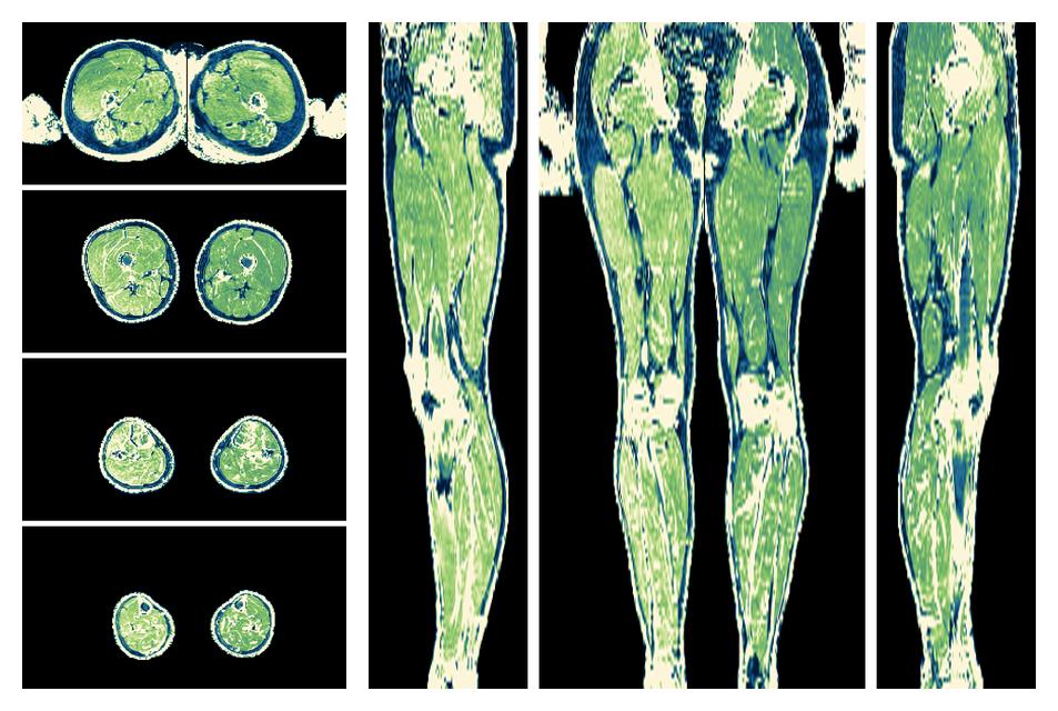 The R2 star relaxation time of the lower extremity obtained from the dixon reconstruction for muscle water fat quantification.