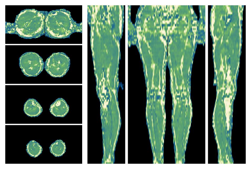 The water only T2 relaxation time of the lower extremity obtained from multi echo spin echo t2 mapping with EPG based reconstruction.