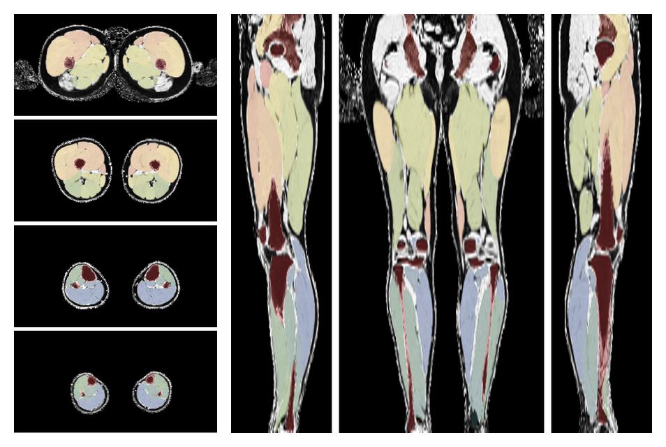 Overlay of automated muscle segmentation labels on dixon water image.