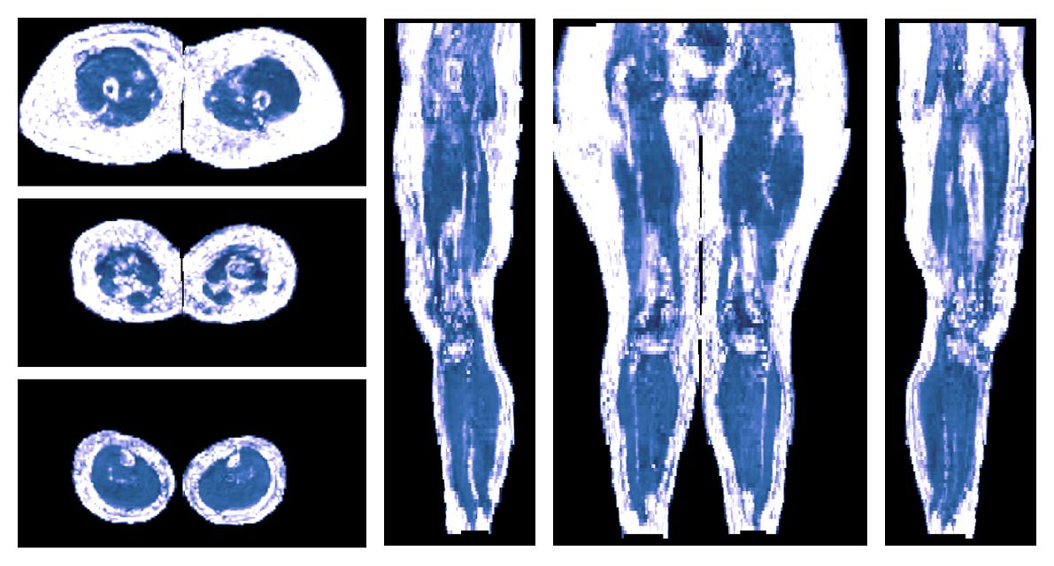 IVIM corrected whole leg muscle fractional anisotropy obtained from diffusion tensor imaging.