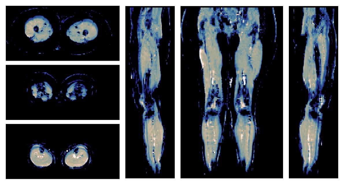 IVIM corrected whole leg muscle mean diffusivity obtained from diffusion tensor imaging.