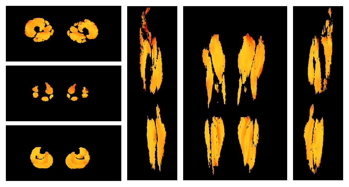 Muscle fiber tract angle map based on whole leg DTI based fiber tractography.