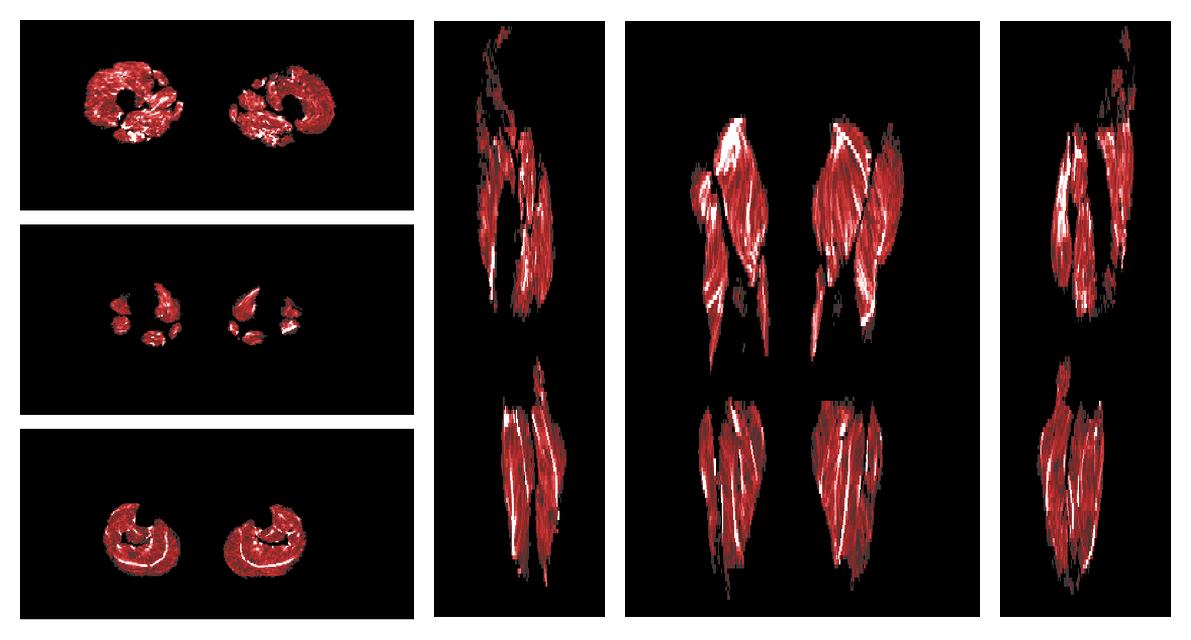 Muscle fiber tract density map based on whole leg DTI based fiber tractography.