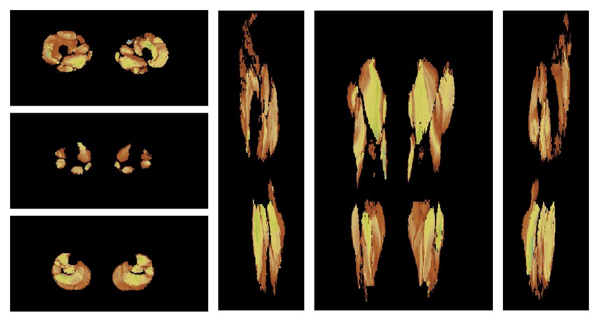 Muscle fiber tract length map based on whole leg DTI based fiber tractography.