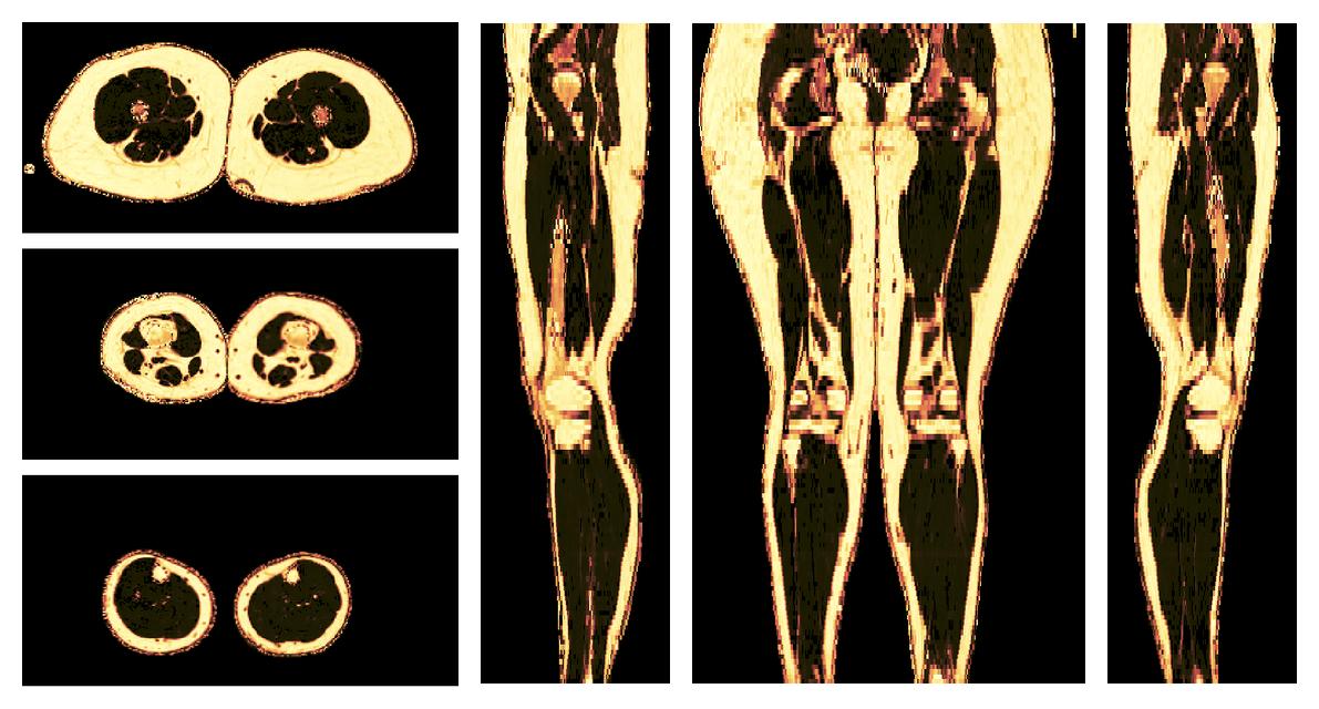 The fat fraction of the lower extremity obtained from the dixon reconstruction for muscle water fat quantification.