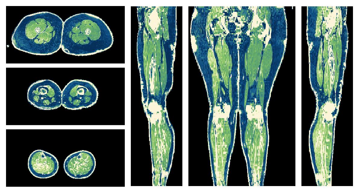 The R2 star relaxation time of the lower extremity obtained from the dixon reconstruction for muscle water fat quantification.