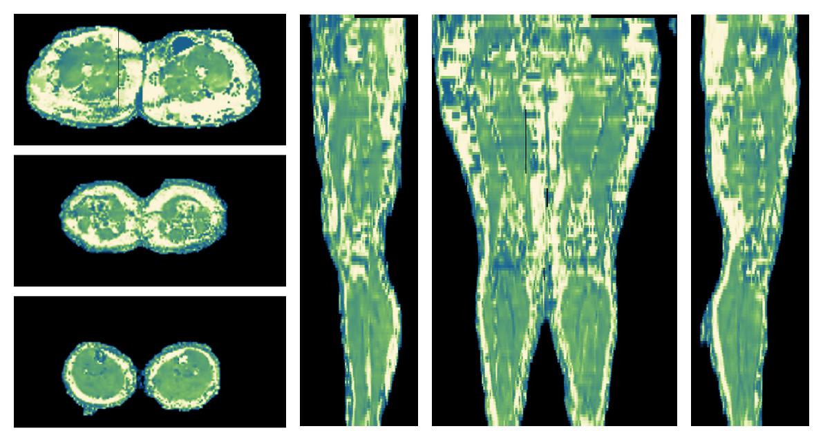 The water only T2 relaxation time of the lower extremity obtained from multi echo spin echo t2 mapping with EPG based reconstruction.