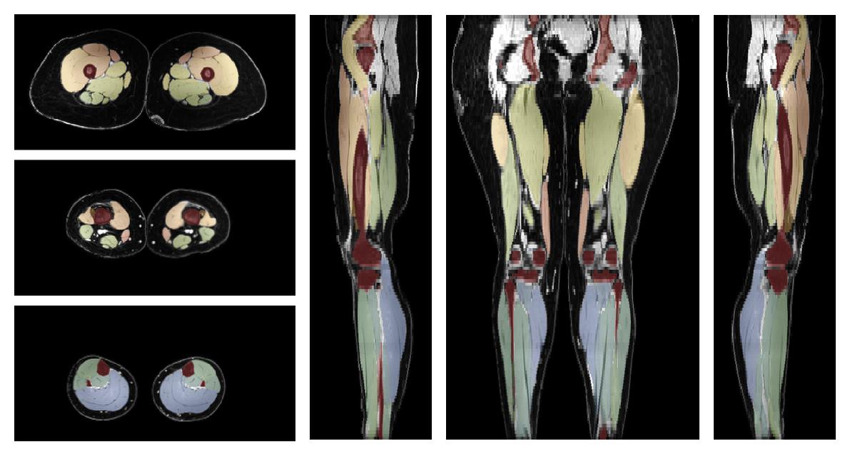 Overlay of automated muscle segmentation labels on dixon water image.