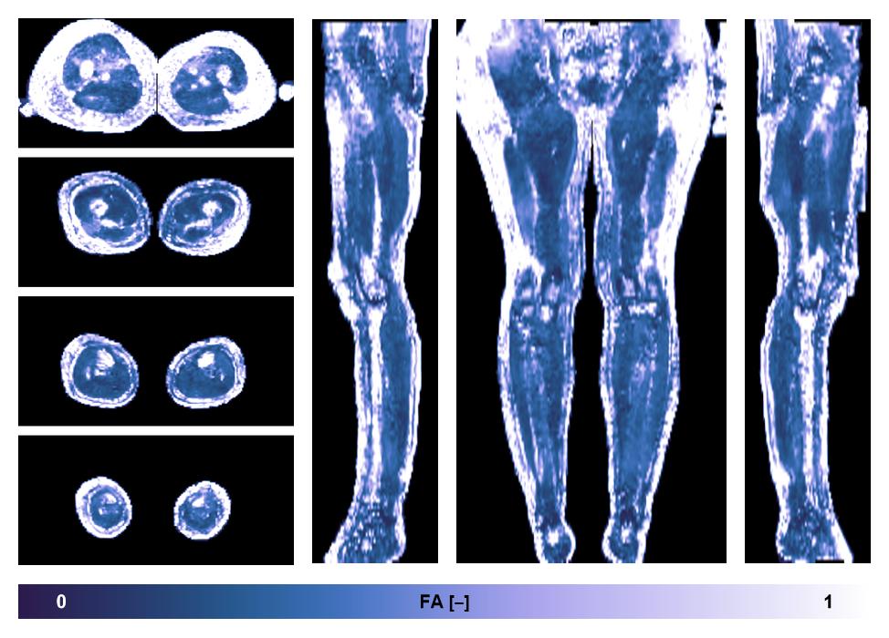 IVIM corrected whole leg muscle fractional anisotropy obtained from diffusion tensor imaging.