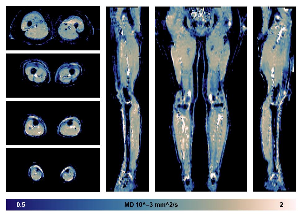 IVIM corrected whole leg muscle mean diffusivity obtained from diffusion tensor imaging.