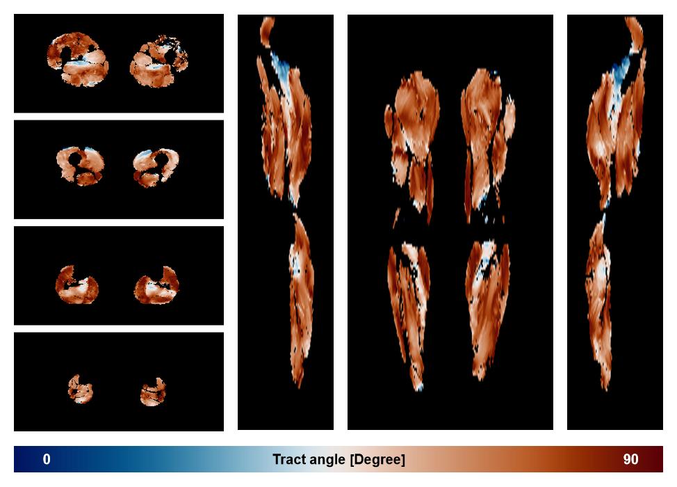 Muscle fiber tract angle map based on whole leg DTI based fiber tractography.