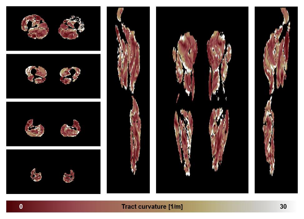 Muscle fiber tract curvature map based on whole leg DTI based fiber tractography.