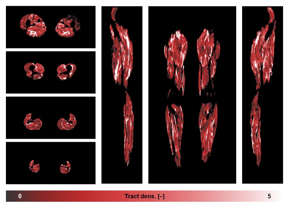 Muscle fiber tract density map based on whole leg DTI based fiber tractography.