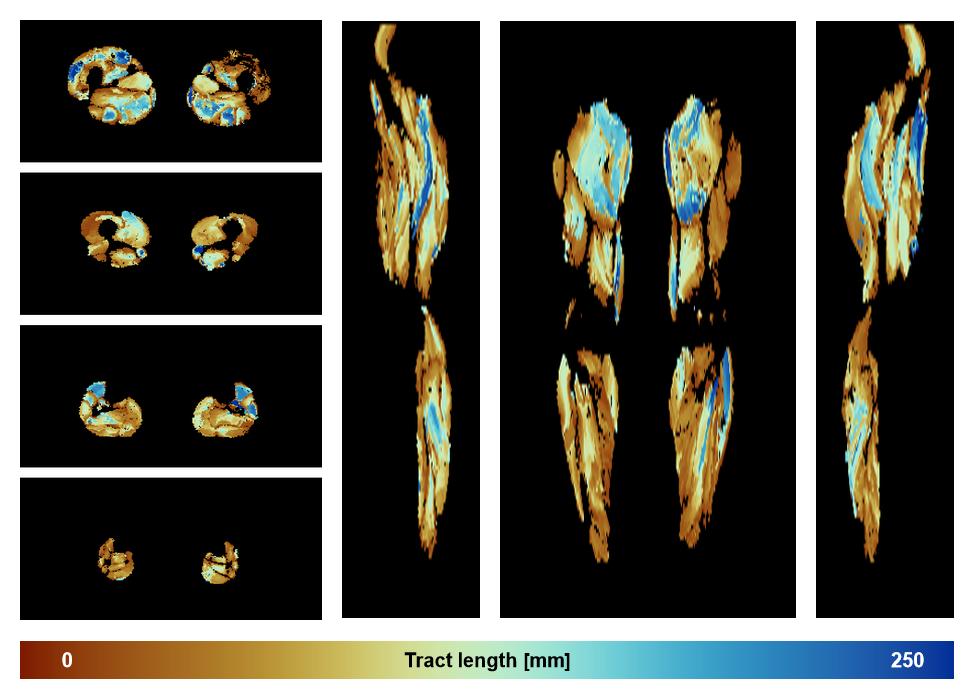 Muscle fiber tract length map based on whole leg DTI based fiber tractography.