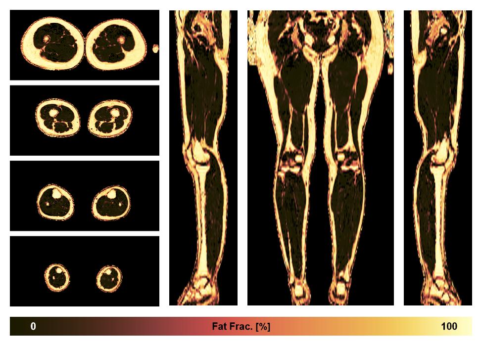 The fat fraction of the lower extremity obtained from the dixon reconstruction for muscle water fat quantification.