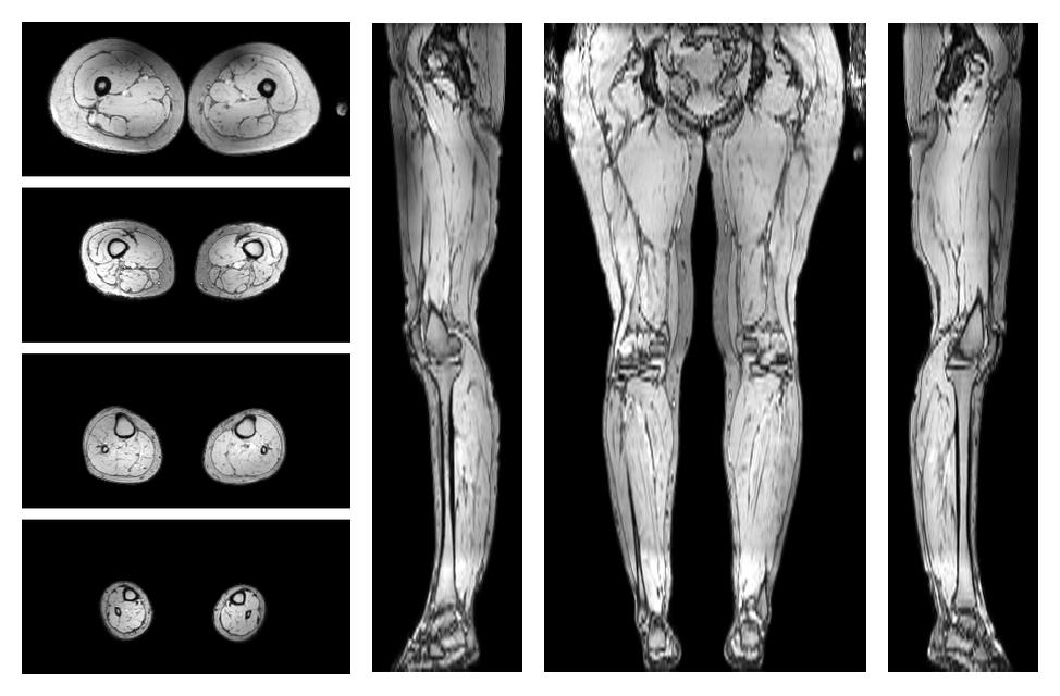 The out-phase image of the dixon reconstruction for water fat quantification.