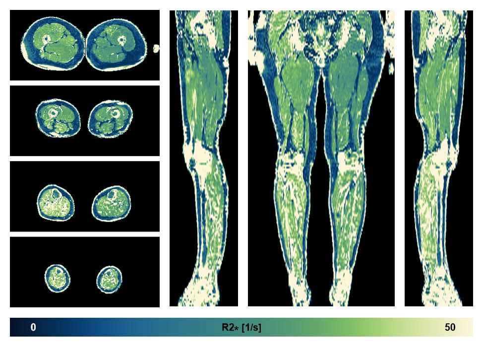 The R2 star relaxation time of the lower extremity obtained from the dixon reconstruction for muscle water fat quantification.