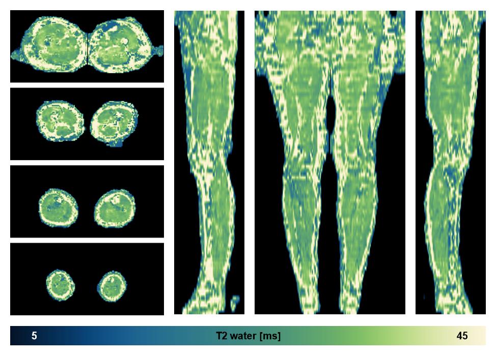 The water only T2 relaxation time of the lower extremity obtained from multi echo spin echo t2 mapping with EPG based reconstruction.