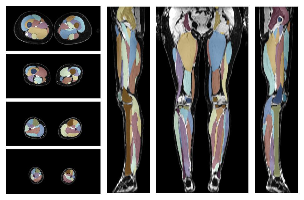 Overlay of automated muscle segmentation labels on dixon water image.