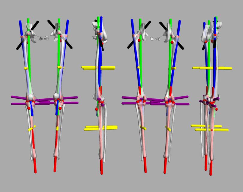 3D render of automated bone segmentation and force lines.