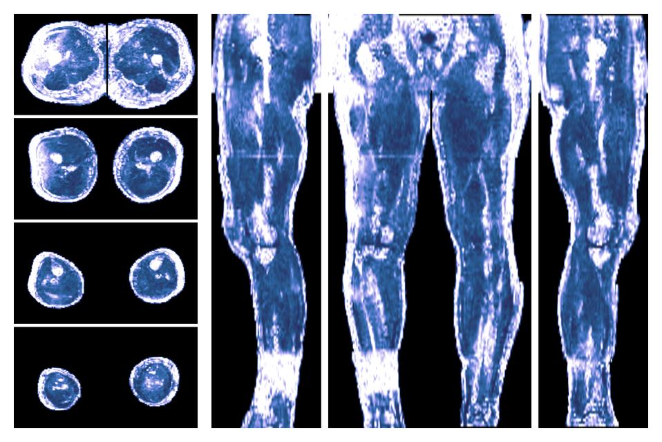 IVIM corrected whole leg muscle fractional anisotropy obtained from diffusion tensor imaging.