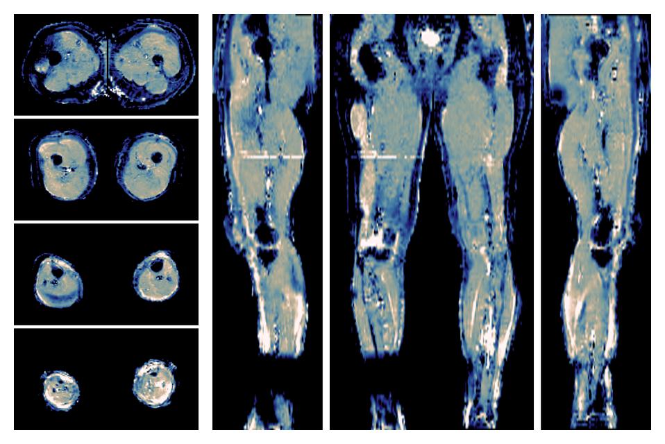 IVIM corrected whole leg muscle mean diffusivity obtained from diffusion tensor imaging.