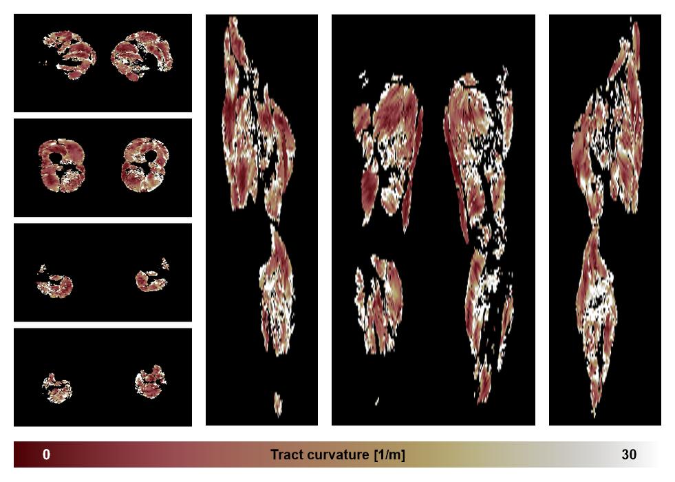 Muscle fiber tract curvature map based on whole leg DTI based fiber tractography.