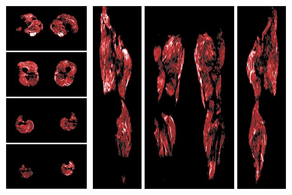 Muscle fiber tract density map based on whole leg DTI based fiber tractography.