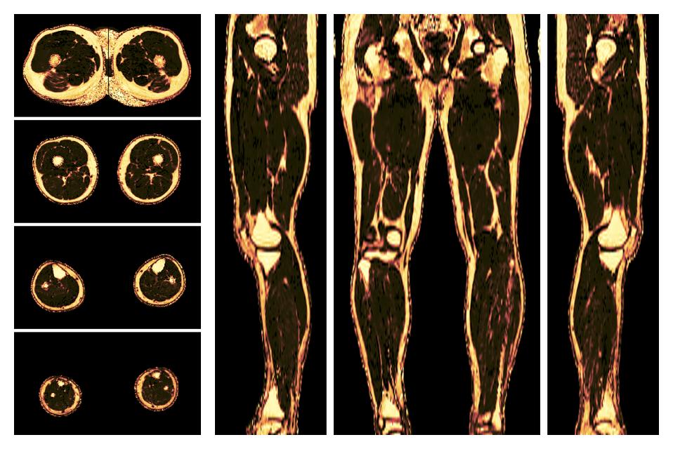 The fat fraction of the lower extremity obtained from the dixon reconstruction for muscle water fat quantification.