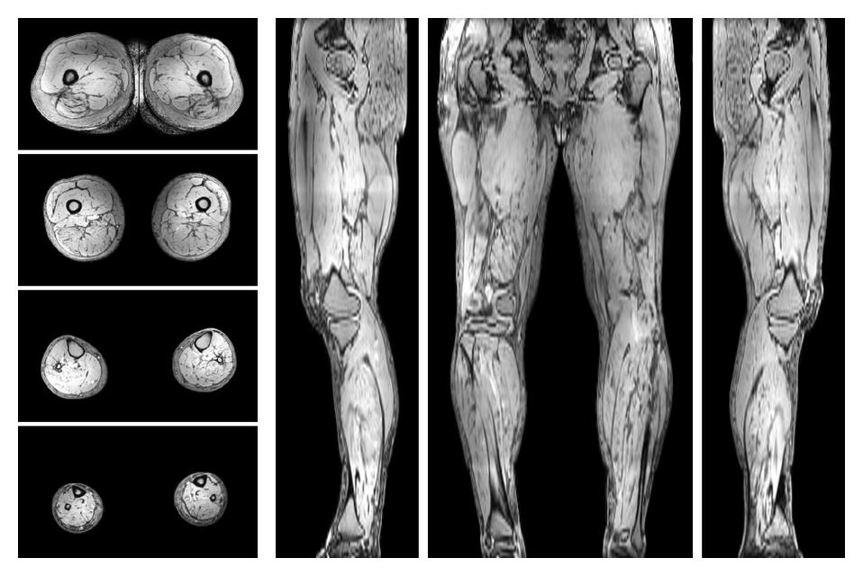 The out-phase image of the dixon reconstruction for water fat quantification.