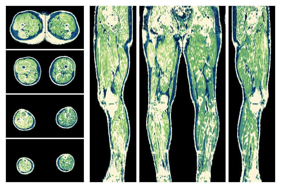 The R2 star relaxation time of the lower extremity obtained from the dixon reconstruction for muscle water fat quantification.