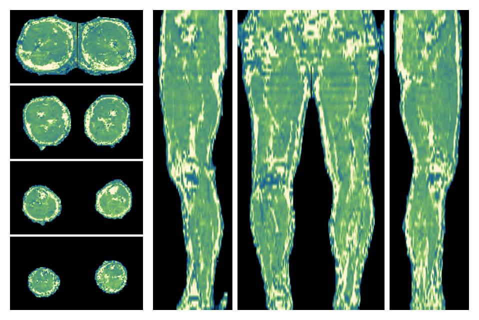 The water only T2 relaxation time of the lower extremity obtained from multi echo spin echo t2 mapping with EPG based reconstruction.