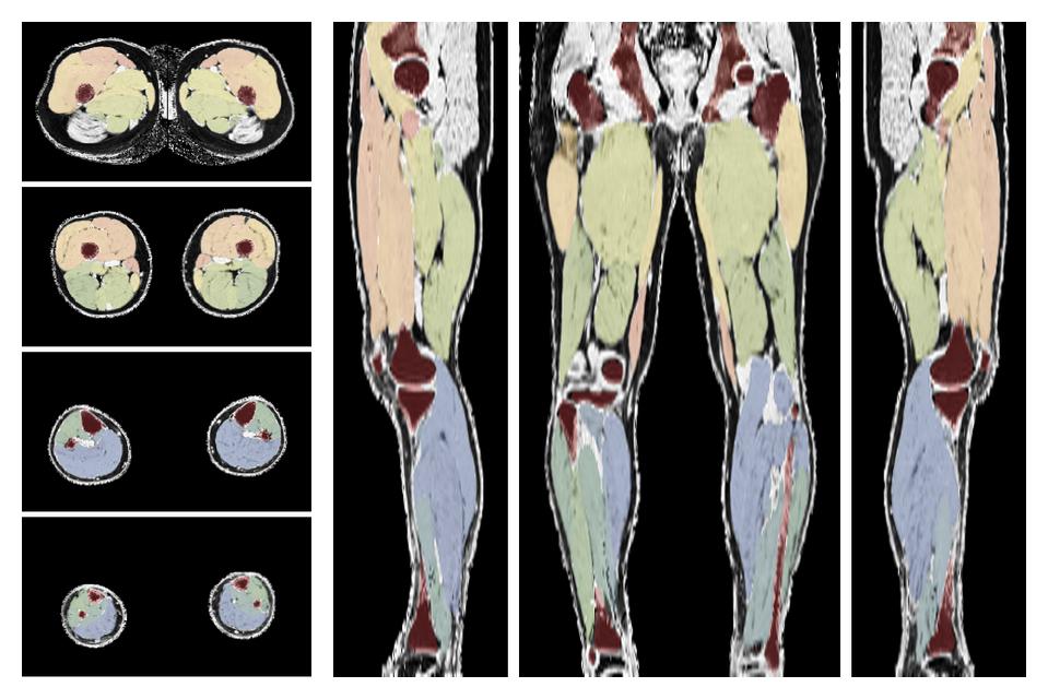 Overlay of automated muscle segmentation labels on dixon water image.