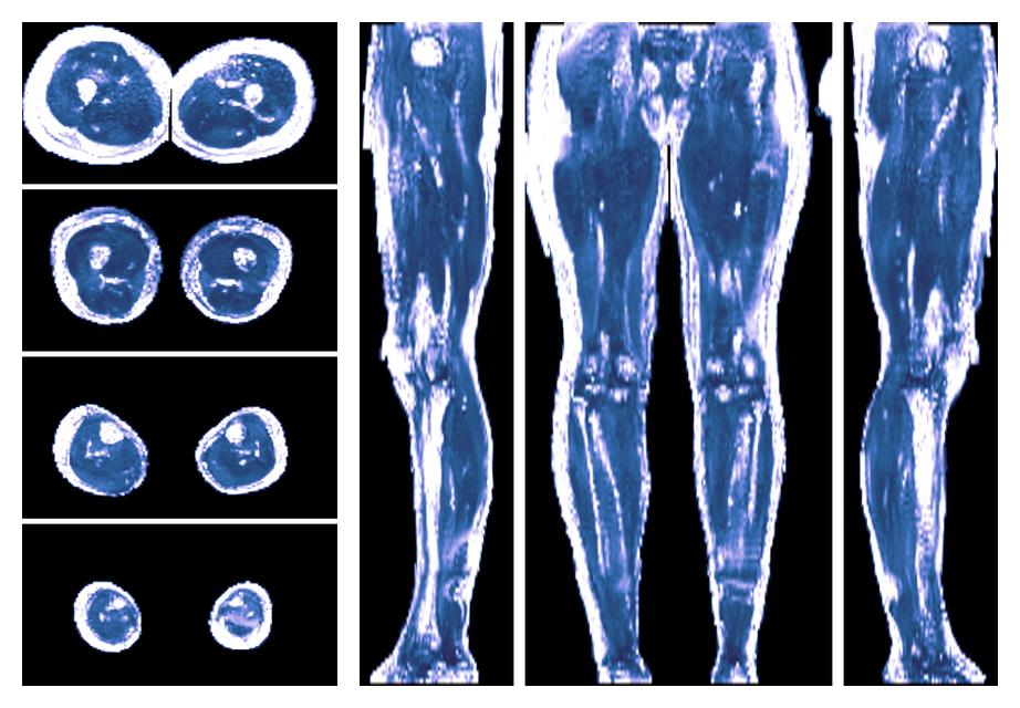 IVIM corrected whole leg muscle fractional anisotropy obtained from diffusion tensor imaging.