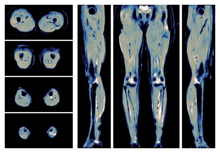 IVIM corrected whole leg muscle mean diffusivity obtained from diffusion tensor imaging.